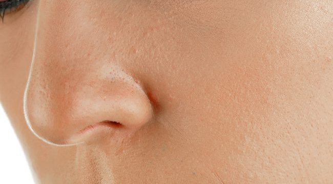 鼻　Ｌ型プロテーゼの効果と失敗・修正や入れ替え！